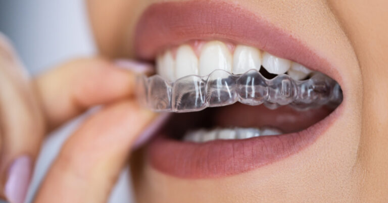 invisalign em ribeirão pires