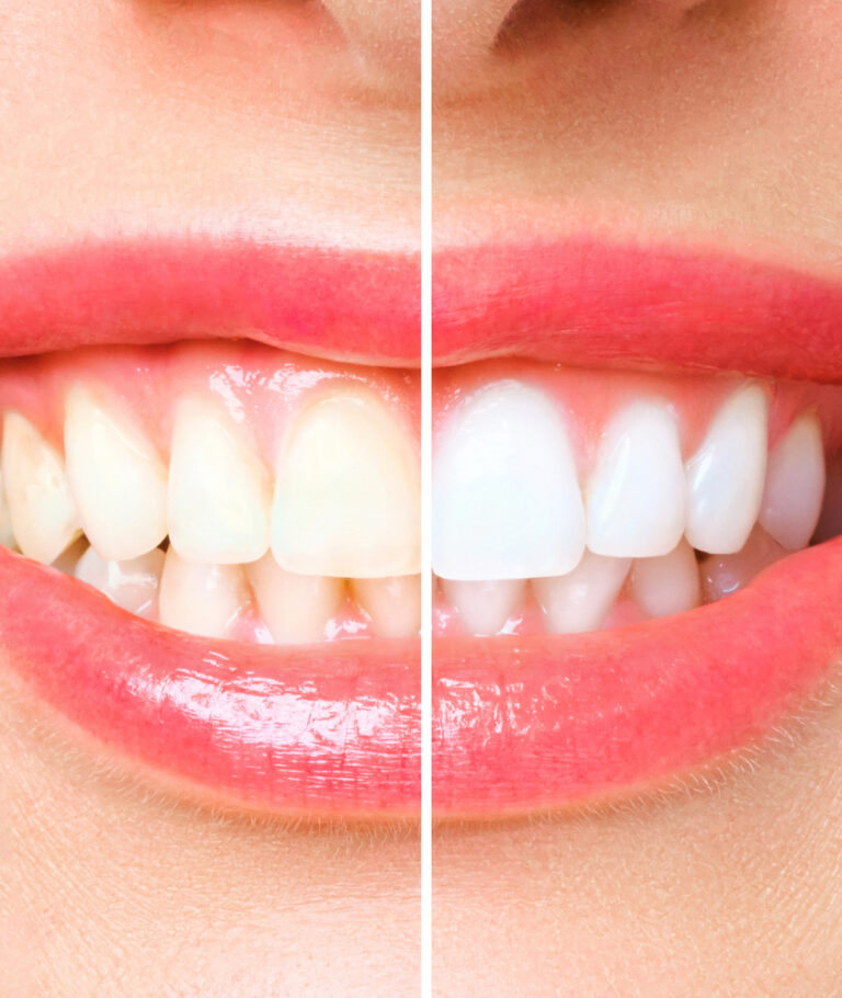 Clareamento Dental em Ribeirão Pires clareamento dental antes e depois