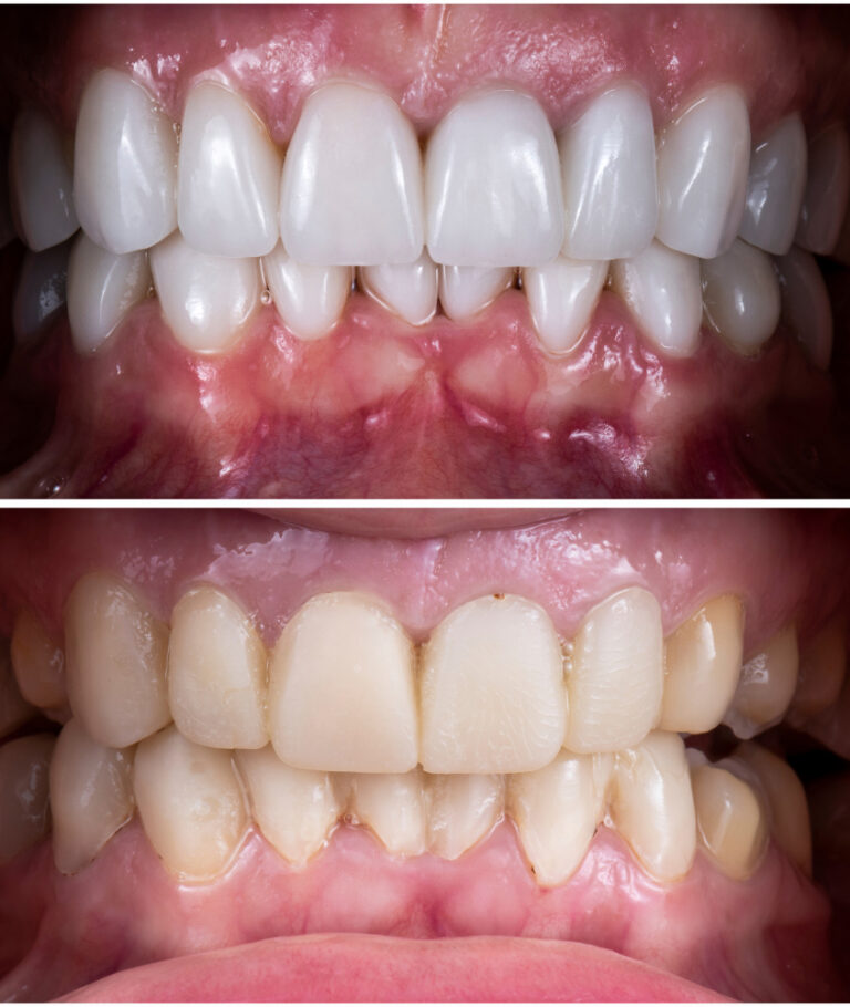Facetas de Porcelana em Ribeirão Pires faceta de porcelana antes e depois