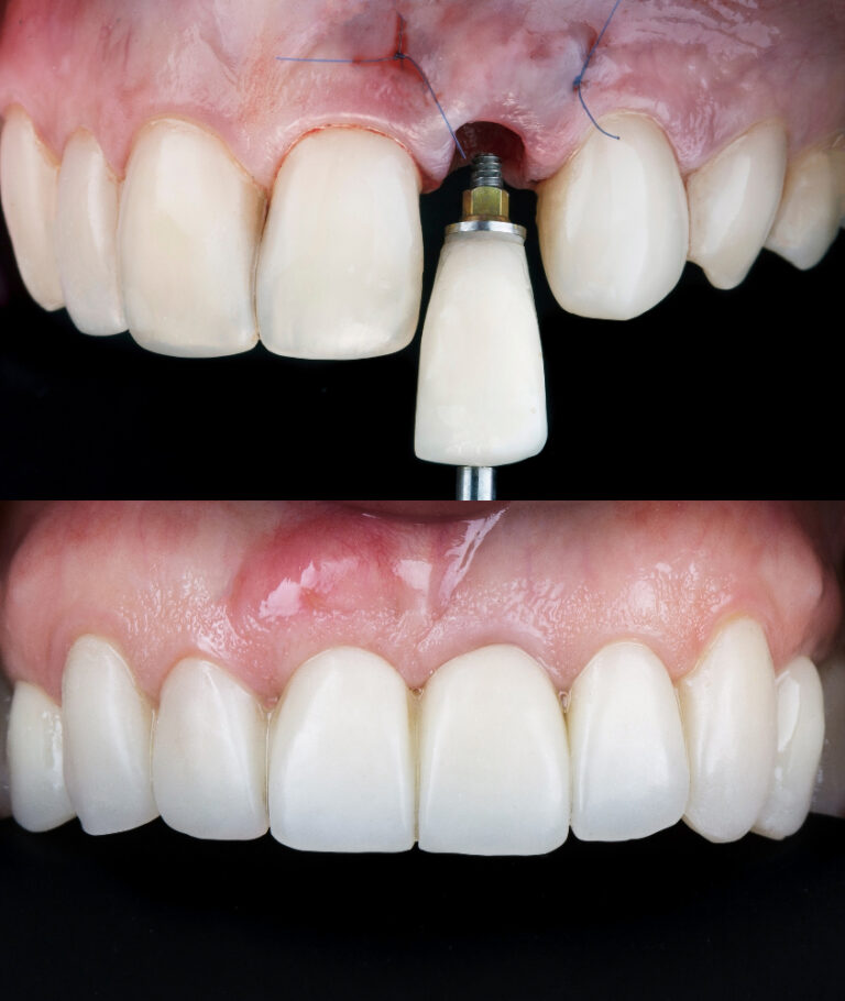 Implante Dentário em Ribeirão Pires implante dentario antes e depois