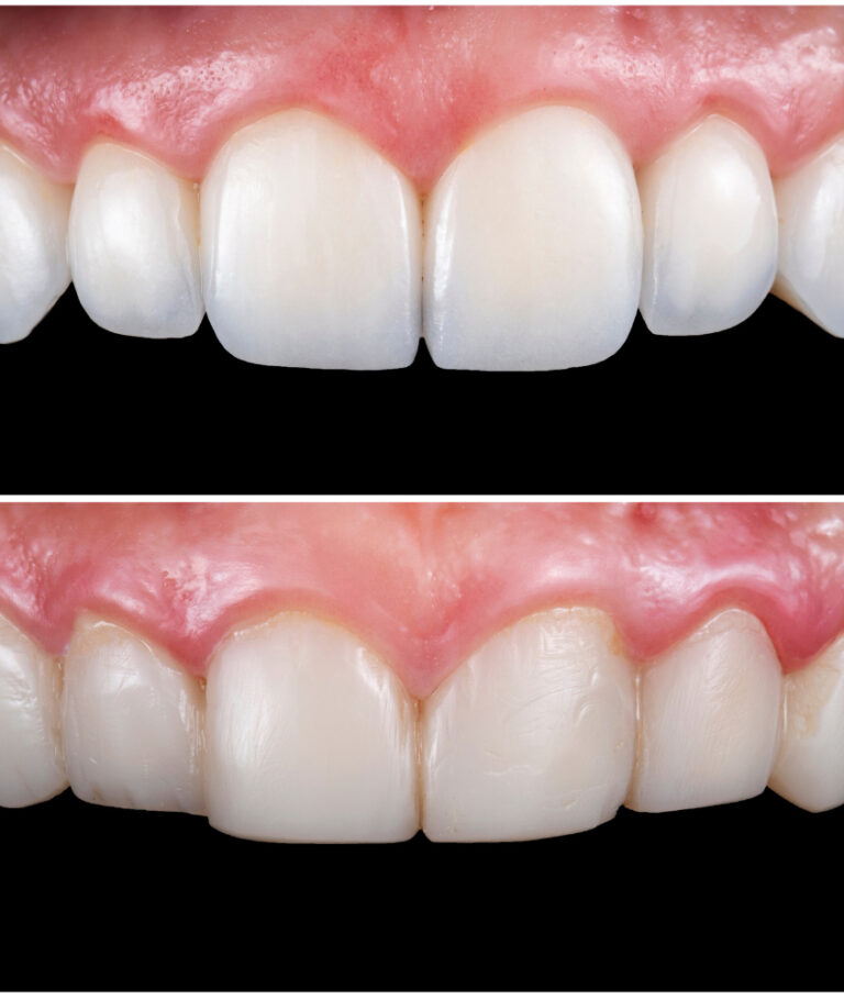 Lentes de Contato Dental em Ribeirão Pires lentes de contato dental antes e depois