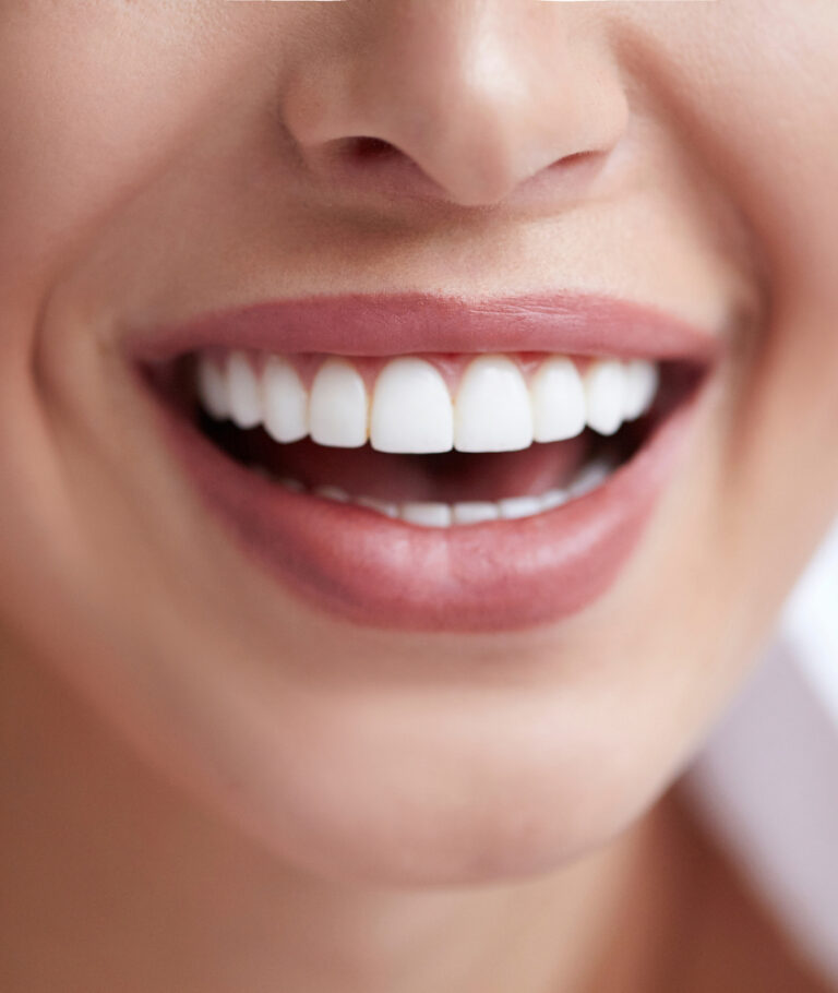 Lentes de Contato Dental em Ribeirão Pires lentes e contato dental