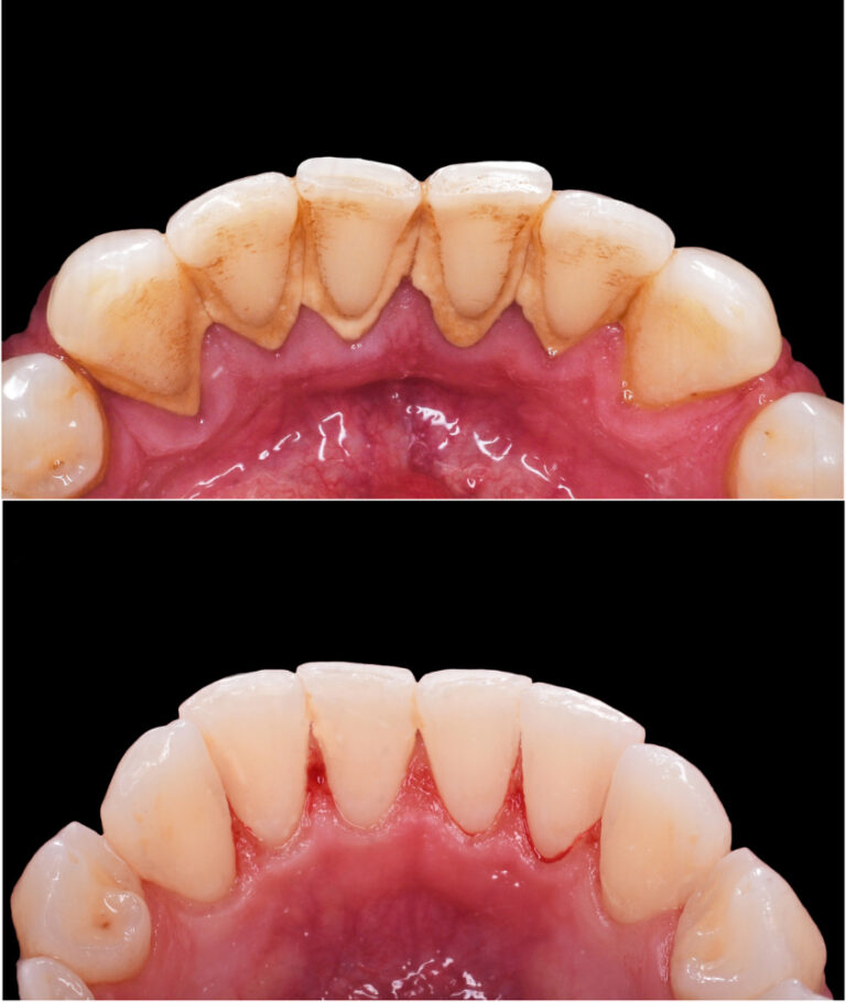 Limpeza nos Dentes em Ribeirão Pires limpeza dental antes e depois