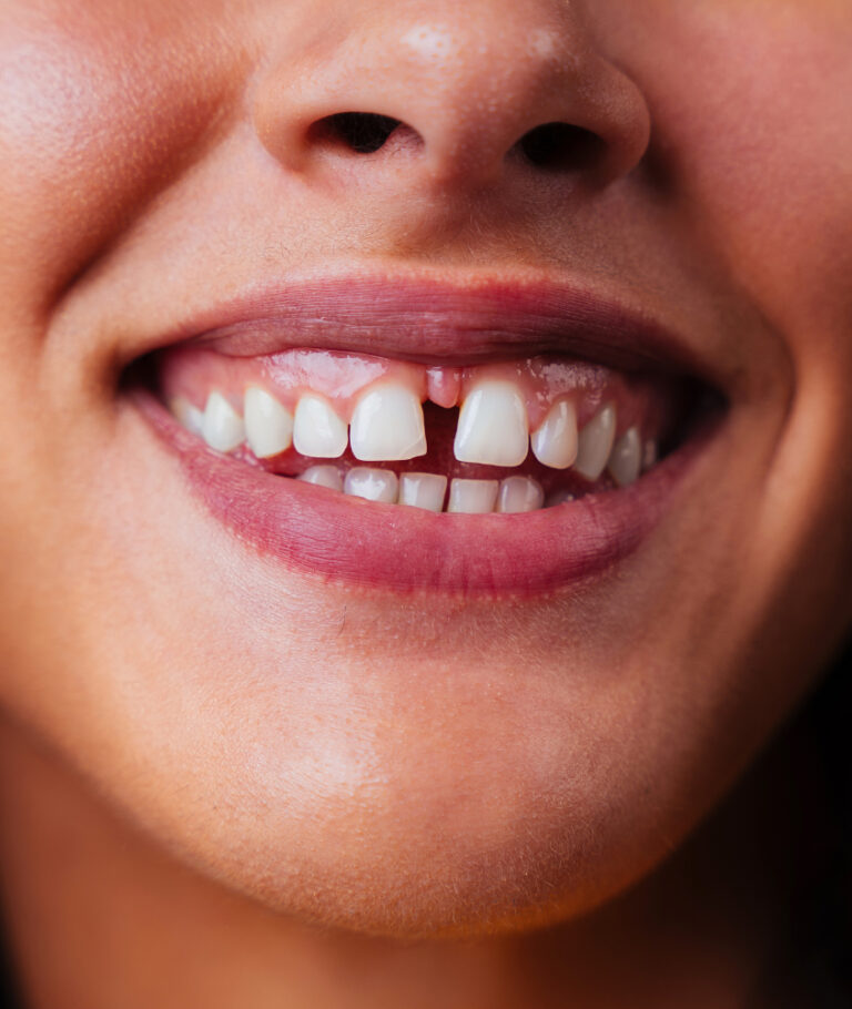Fechamento de Diastema em Ribeirão Pires o que e diastema
