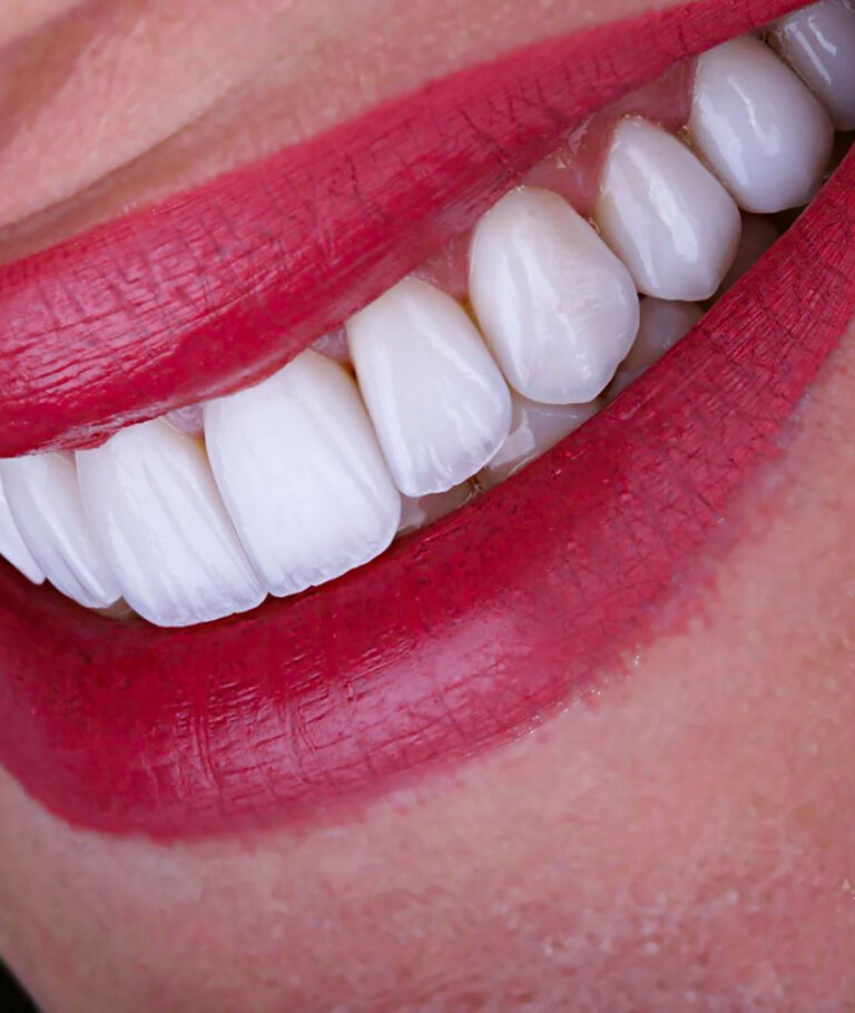 Facetas de Porcelana em Ribeirão Pires o que e faceta de porcelana