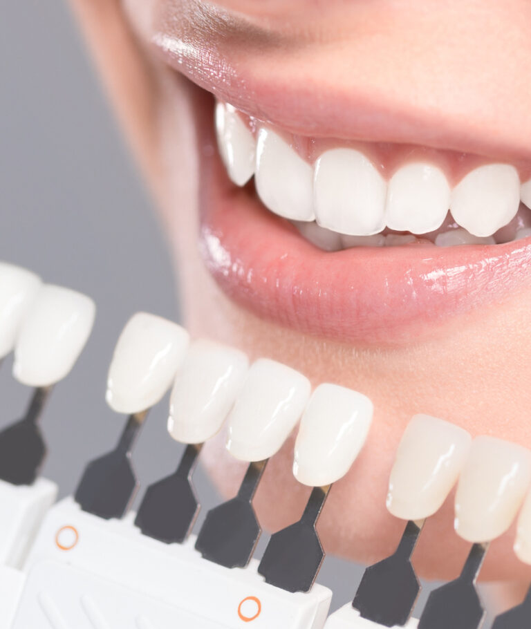 Lentes de Contato Dental em Ribeirão Pires o que é lente de contato dental