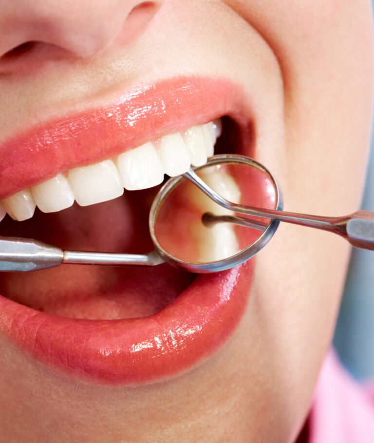 Restauração Dentária em Ribeirão Pires restauração dental